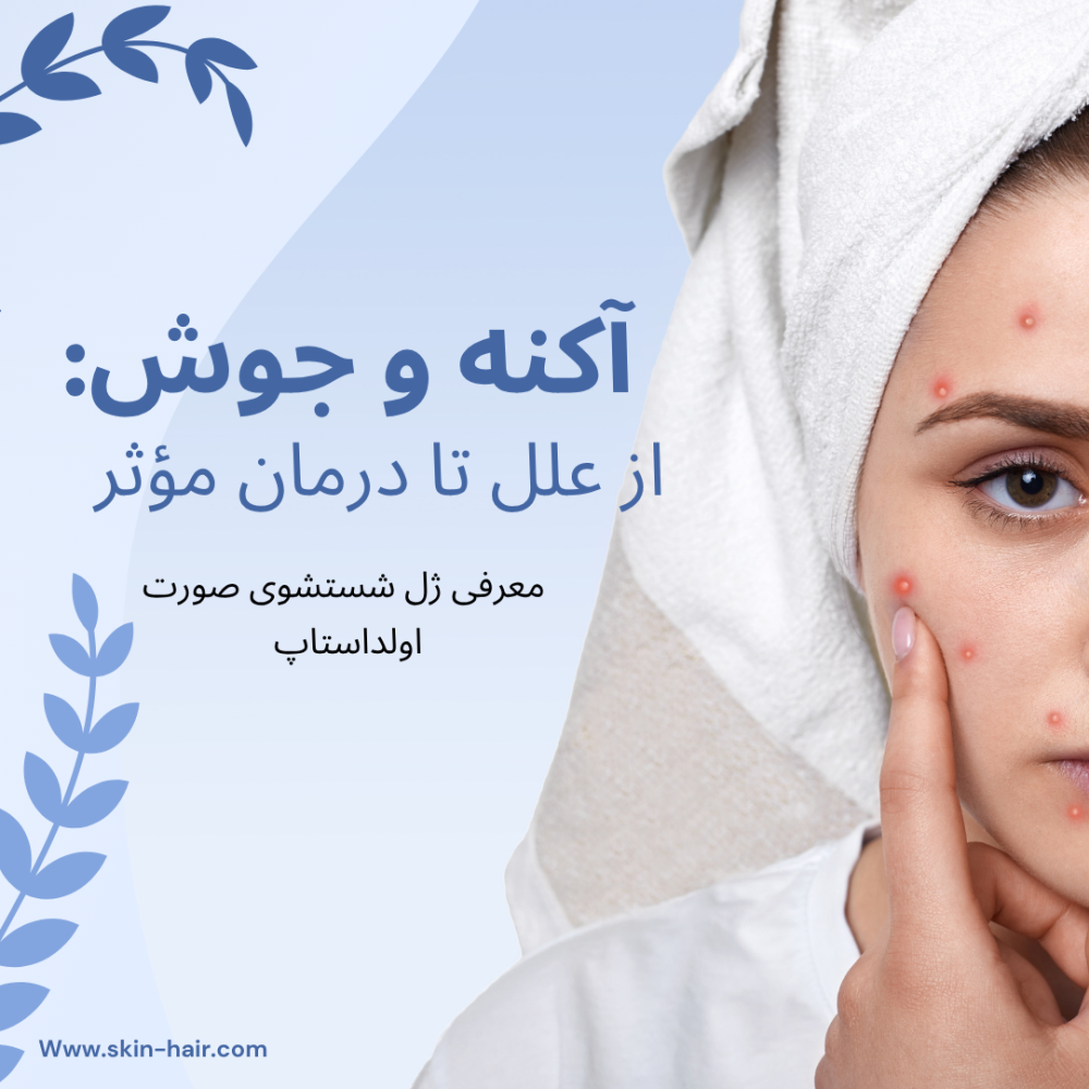 آکنه و جوش: از علل تا درمان مؤثر 